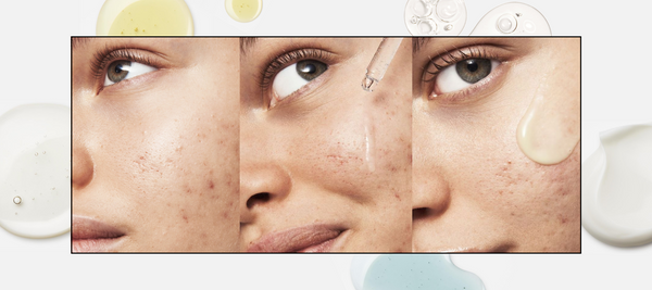Top Acne Treatments of 2023 for Clearer, Glowing Skin